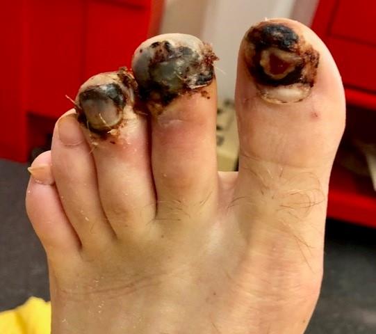Fife-Trauatic Toe Injury with Necrosis